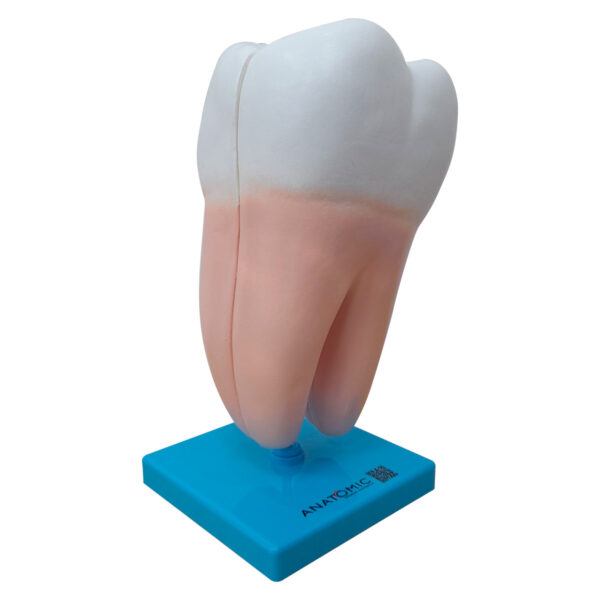 Dente Molar Ampliado – Saudável e com Cárie - Imagem 4