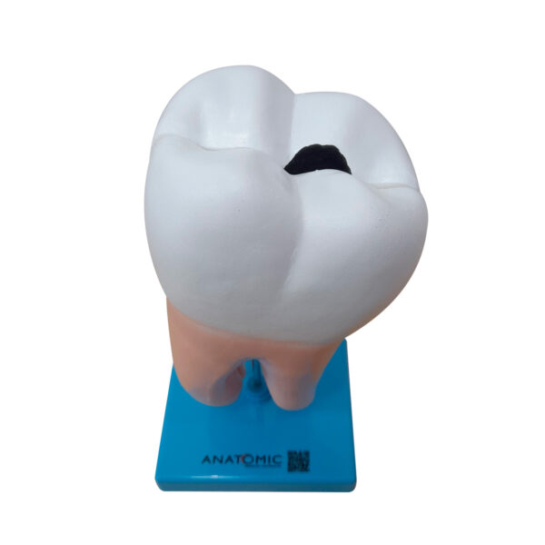 Dente Molar Ampliado – Saudável e com Cárie - Imagem 2