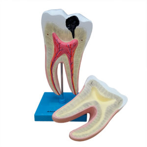 Dente Molar Ampliado – Saudável e com Cárie